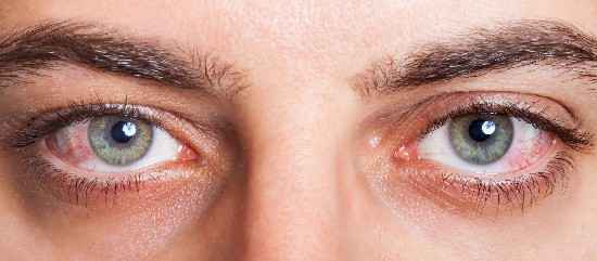 remedies for watery eyes